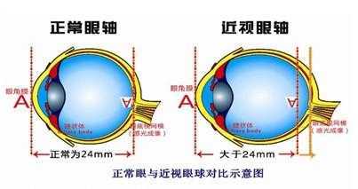 高度近视有什么危害